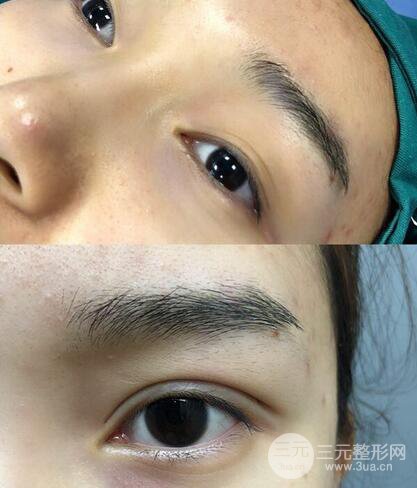 蘇北人民醫(yī)院李平松雙眼皮案例日記