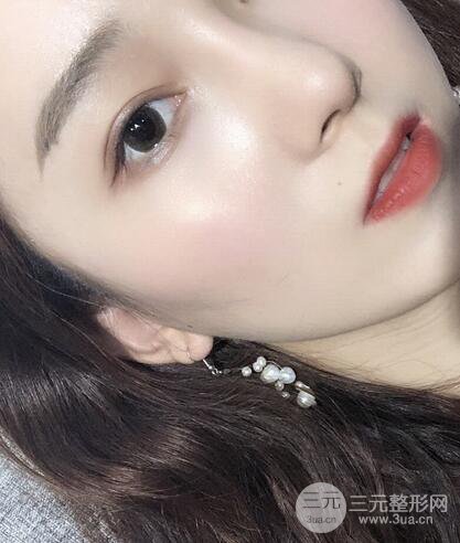 蘇北人民醫(yī)院李平松雙眼皮案例日記