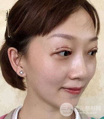 北京雙眼皮失敗修復(fù)手術(shù)日記分享，附上前后對比照片