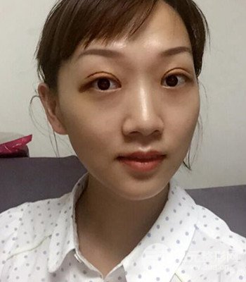 北京雙眼皮失敗修復(fù)手術(shù)日記分享，附上前后對比照片