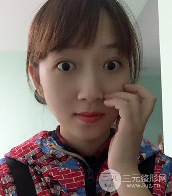 北京雙眼皮失敗修復(fù)手術(shù)日記分享，附上前后對比照片