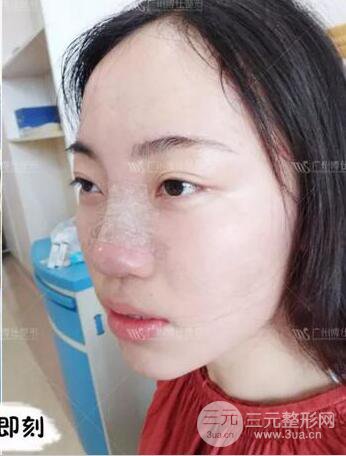 廣州博仕隆鼻失敗修復案例，前后恢復過程分享~