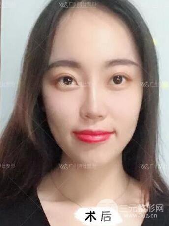 廣州博仕隆鼻失敗修復案例，前后恢復過程分享~