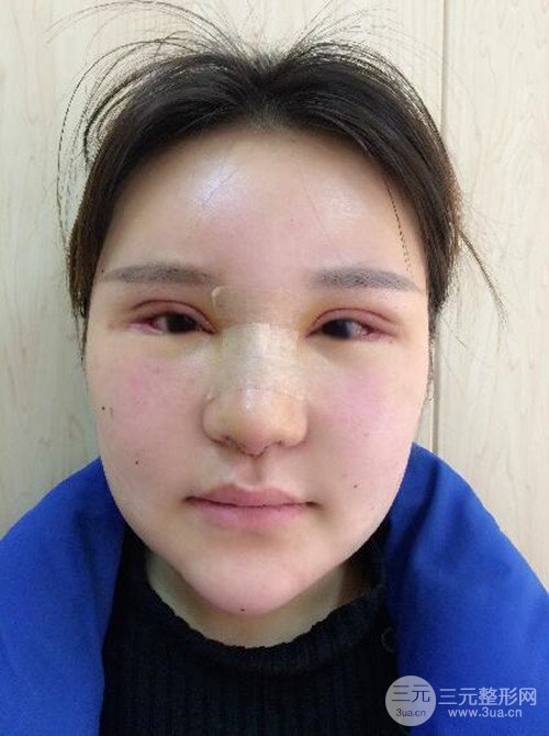 上海麗質(zhì)呂成醫(yī)生做的吸脂瘦臉日記，前后恢復(fù)圖分享