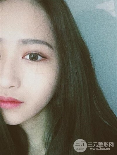 廣州曙光劉杰偉醫(yī)生切開雙眼皮案例，前后對比圖分享