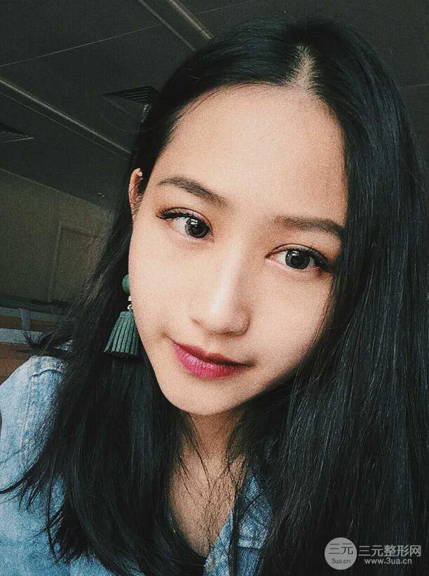 廣州曙光劉杰偉醫(yī)生切開雙眼皮案例，前后對比圖分享