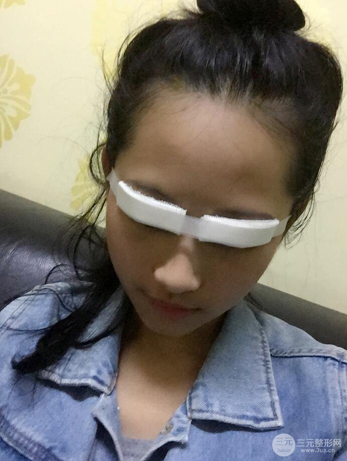 廣州曙光劉杰偉醫(yī)生切開雙眼皮案例，前后對比圖分享