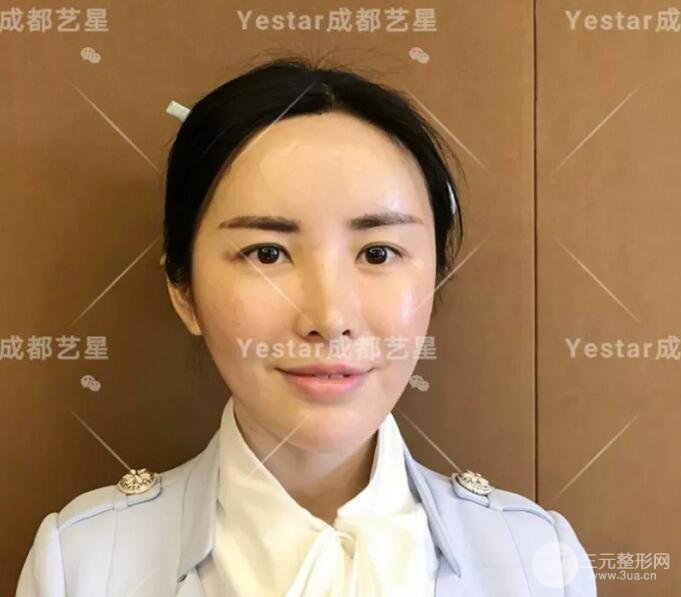 成都藝星蔡靈自體脂肪面部填充術后果記錄