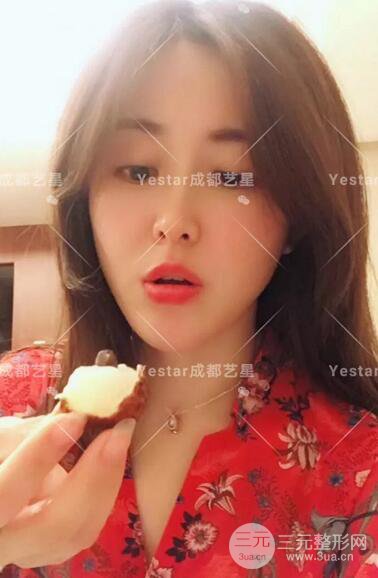 成都藝星蔡靈自體脂肪面部填充術后果記錄