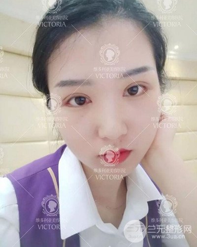 南京維多利亞切開雙眼皮+開眼角案例分享，附上前后對比圖