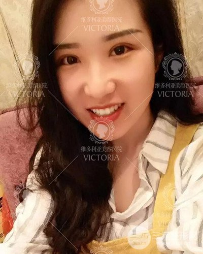 南京維多利亞切開雙眼皮+開眼角案例分享，附上前后對比圖