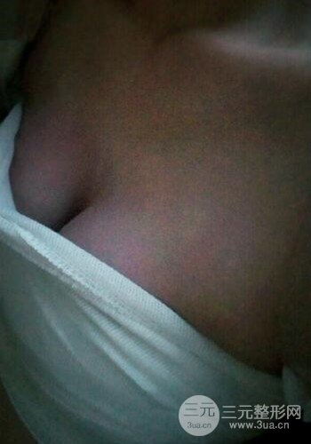 深圳假體隆胸讓平胸妹華麗變身，手術(shù)果分享