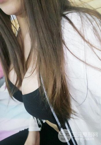 深圳假體隆胸讓平胸妹華麗變身，手術(shù)果分享