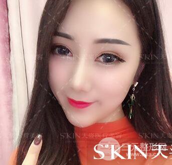 汪海濱雙眼皮+隆鼻案例術(shù)后100天日記~