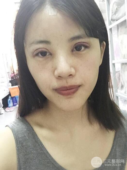 北京禾美嘉任學(xué)會自體脂肪面部填充案例分享