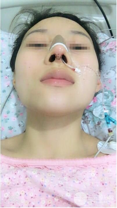 武漢亞太程曉林做鼻子好嗎？隆鼻案例日記