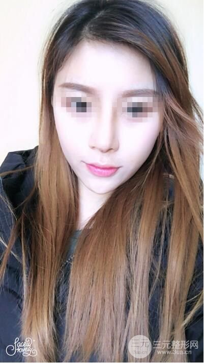 武漢亞太程曉林做鼻子好嗎？隆鼻案例日記