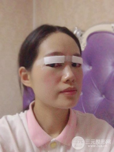 廣州晨曦切開雙眼皮恢復(fù)日記分享，附上前后對比圖