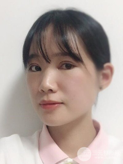 廣州晨曦切開雙眼皮恢復(fù)日記分享，附上前后對比圖