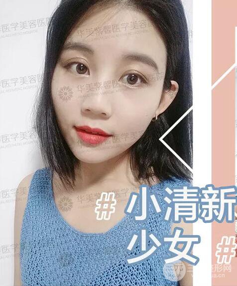 四川華美紫馨自體脂肪面部案例術后恢復日記