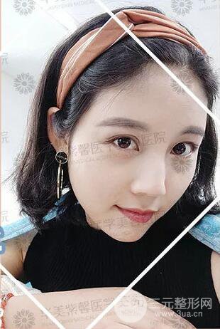 四川華美紫馨自體脂肪面部案例術后恢復日記