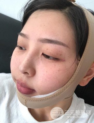 面部吸脂瘦臉手術(shù)日記分享，瘦臉果驚人