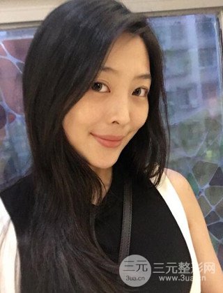 面部吸脂瘦臉手術(shù)日記分享，瘦臉果驚人