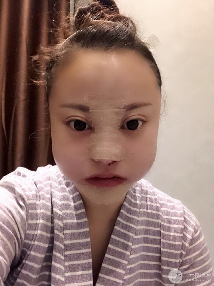 太原麗都面部吸脂+假體隆鼻案例分享，精致面部小V臉了解一下~
