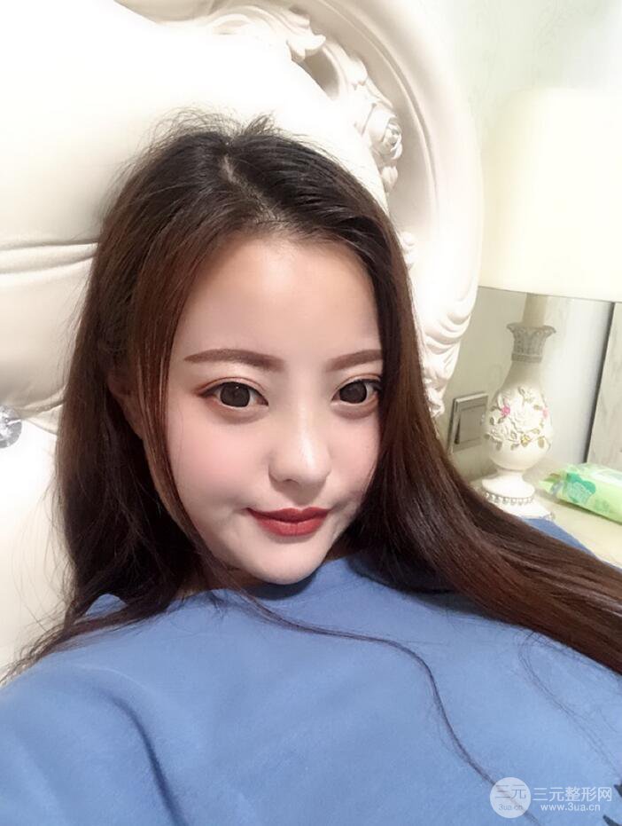 太原麗都面部吸脂+假體隆鼻案例分享，精致面部小V臉了解一下~