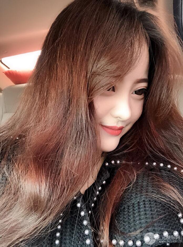 太原麗都面部吸脂+假體隆鼻案例分享，精致面部小V臉了解一下~