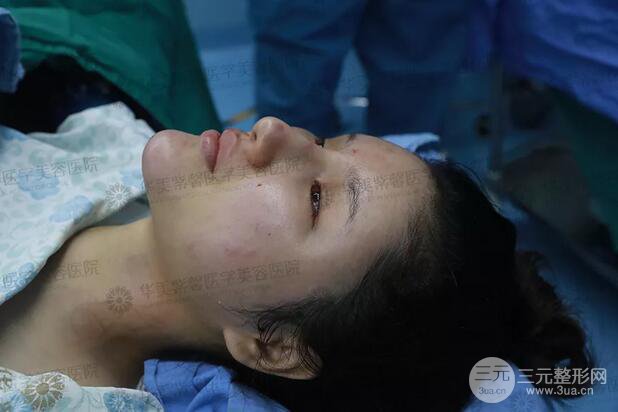 四川華美紫馨艾玉峰自體脂肪填充案例術(shù)后日記