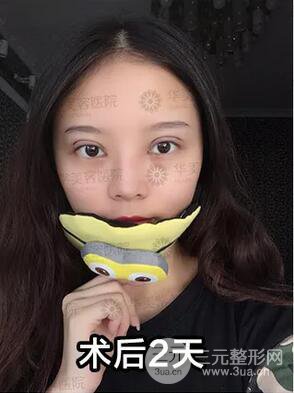 華美紫馨邱偉雙眼皮案例術(shù)后7天果圖分享