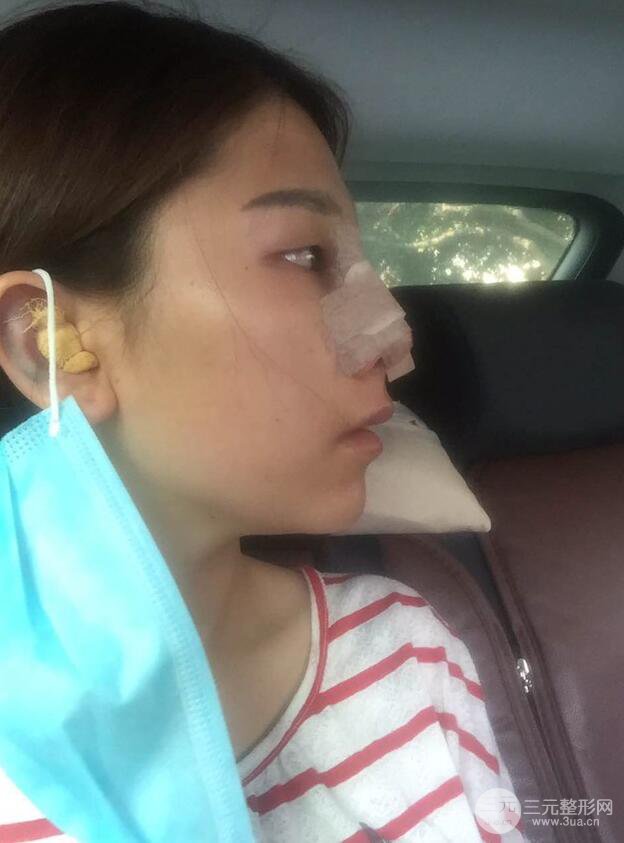 成都武侯星范劉向文自體耳軟骨隆鼻案例分享