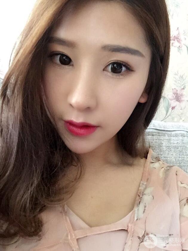 成都武侯星范劉向文自體耳軟骨隆鼻案例分享