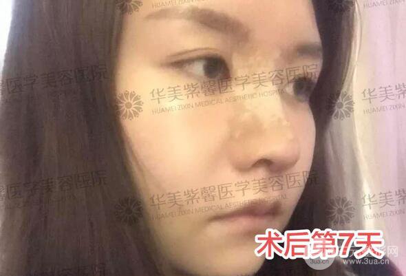 華美紫馨邱偉做的隆鼻術(shù)后10天驚人果分享！