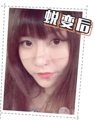 華美紫馨邱偉做的隆鼻術(shù)后10天驚人果分享！