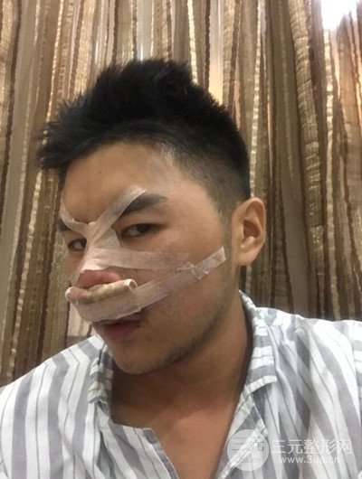 成都玉之光黃開亮醫(yī)生隆鼻修復(fù)整形案例，前后恢復(fù)過程分享