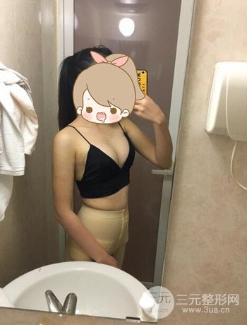 北京自體脂肪隆胸手術(shù)日記分享，豐胸術(shù)后恢復(fù)果圖