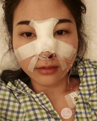 膨體隆鼻案例分享，四川華人醫(yī)療游曉波醫(yī)生做的!