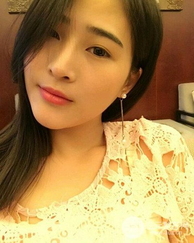 膨體隆鼻案例分享，四川華人醫(yī)療游曉波醫(yī)生做的!