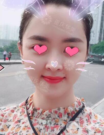 四川華美紫馨秦曉自體脂肪填充案例合集