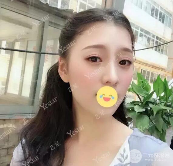 成都藝星6d明星眼雙眼皮術(shù)后恢復(fù)日記