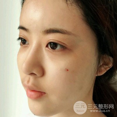 上海百*麗顧清自體脂肪填充面部案例分享