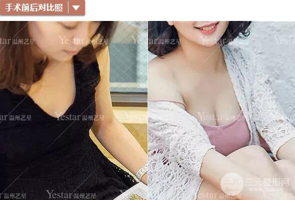溫州藝星譚立文自體脂肪隆胸案例術(shù)后恢復(fù)實(shí)記