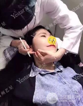 溫州藝星打B****案例術(shù)后恢復(fù)日記