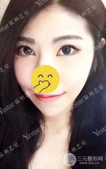 溫州藝星打B****案例術(shù)后恢復(fù)日記