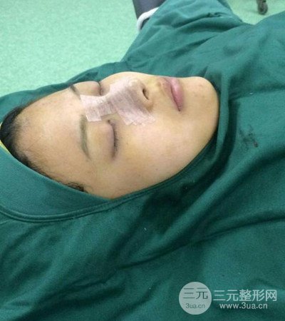 四川軍大鐘正強(qiáng)隆鼻案例日記分享