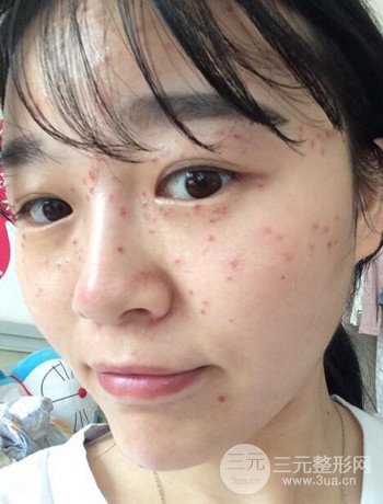 北京激光去雀斑真實案例分享，純素顏無濾鏡果圖