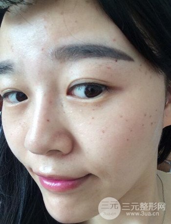 北京激光去雀斑真實案例分享，純素顏無濾鏡果圖
