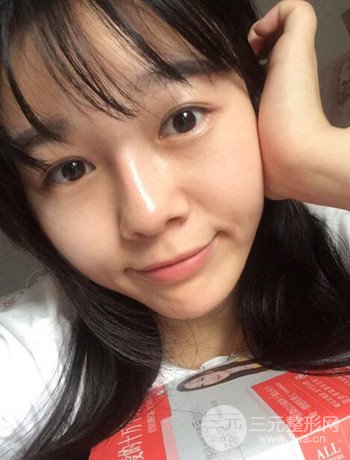 北京激光去雀斑真實案例分享，純素顏無濾鏡果圖